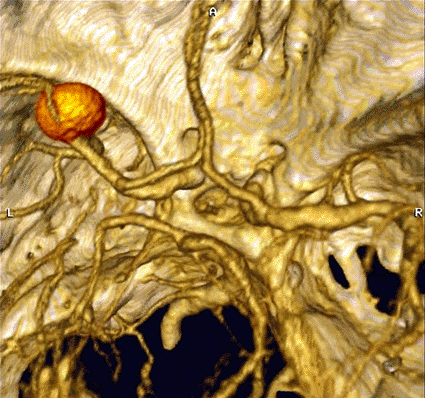 Image: Three-dimensional colored computed tomography (CT) scan of an aneurysm (upper left) in a blood vessel of the brain (Photo courtesy of CIMN, ISM / SPL).